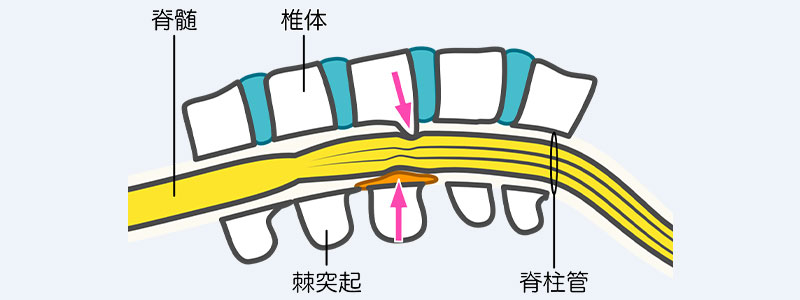 脊柱管狭窄症イメージ
